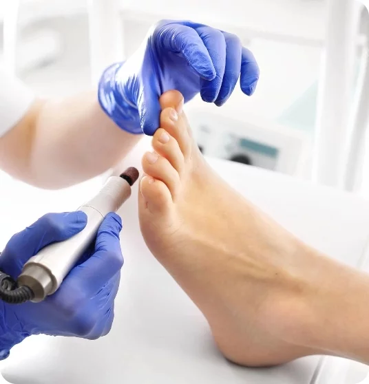 Terapia brodawek wirusowych