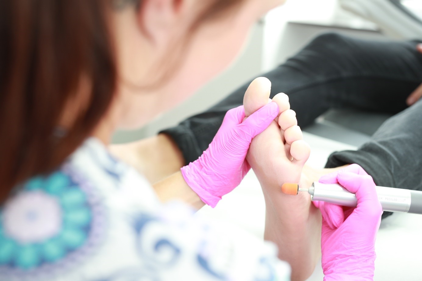 Usunięcie odcisków, modzeli